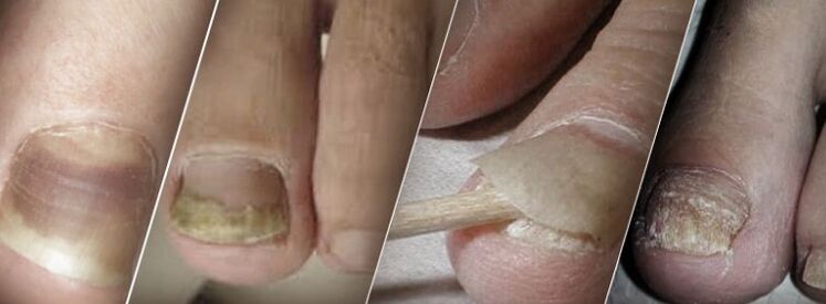 Onchomycosis
