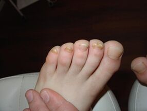 Onchomycosis