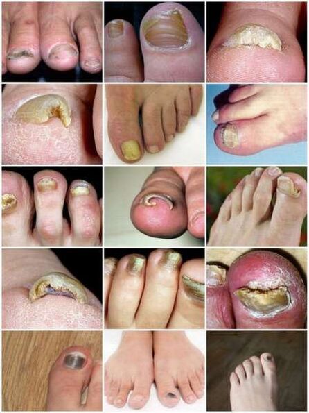 A körömlemez gombás fertőzése