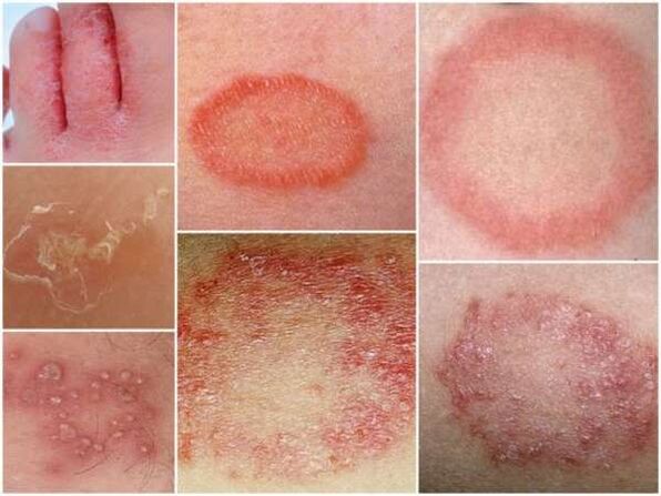 A lábak bőrének trichophytosise